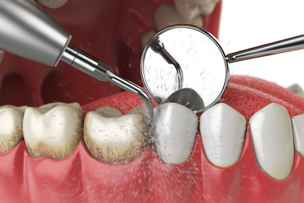 Diagram of teeth and gum cleaning